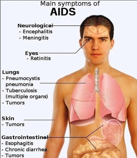 symptoms of aids diagram