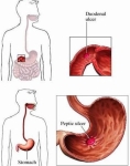 symptoms peptic ulcers