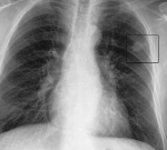 thorax pa peripheres bronchialcarcinom li of markiert