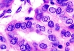 thyroid papillary carcinoma histopathology