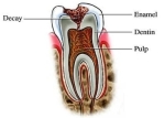 tooth decay