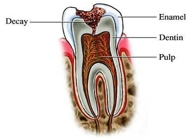 tooth decay photo
