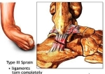 type angle sprain