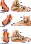 types of ankle sprains