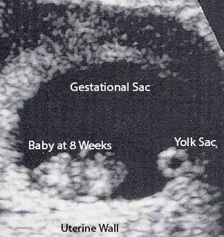 ultrasoud weeks