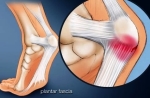 webmd rf plantar fascia