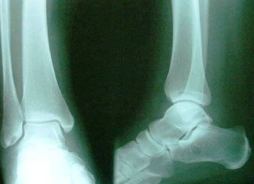 xray normal ankle pic
