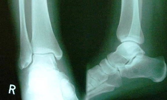 xray normal ankle
