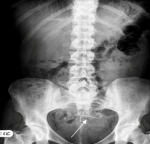 xray of stomach cancer figure